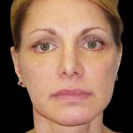 Facelift Before & After Patient #1754