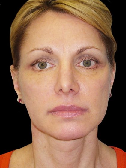 Facelift Before & After Patient #1754