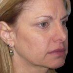 Facelift Before & After Patient #1754