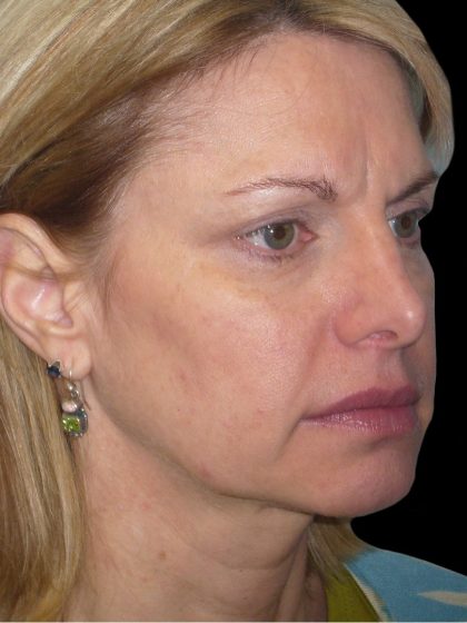 Facelift Before & After Patient #1754