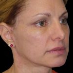 Facelift Before & After Patient #1754