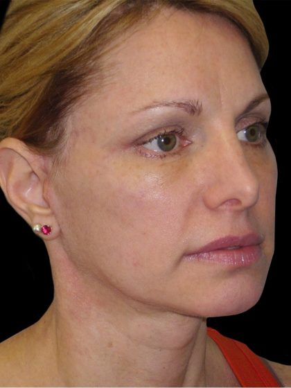 Facelift Before & After Patient #1754