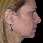 Facelift Before & After Patient #1754