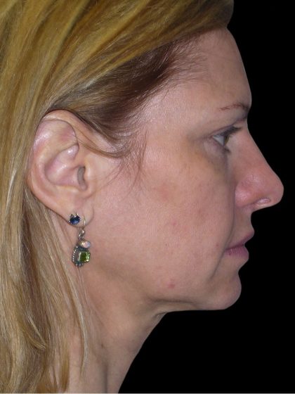 Facelift Before & After Patient #1754