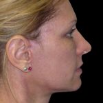 Facelift Before & After Patient #1754