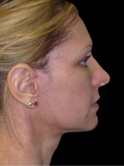 Facelift Before & After Patient #1754