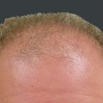 Hair Restoration Before & After Patient #1792