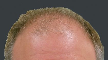 Hair Restoration Before & After Patient #1792