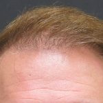 Hair Restoration Before & After Patient #1792