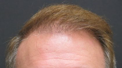 Hair Restoration Before & After Patient #1792