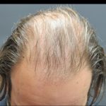 Hair Restoration Before & After Patient #1795