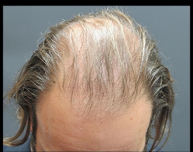 Hair Restoration Before & After Patient #1795