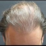 Hair Restoration Before & After Patient #1795