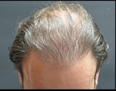 Hair Restoration Before & After Patient #1795