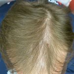 Hair Restoration Before & After Patient #1798