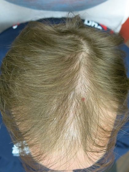 Hair Restoration Before & After Patient #1798