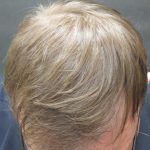 Hair Restoration Before & After Patient #1798