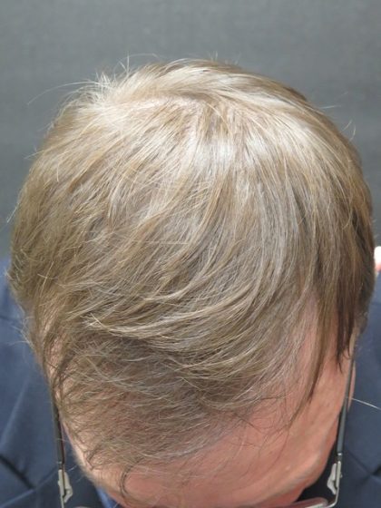 Hair Restoration Before & After Patient #1798