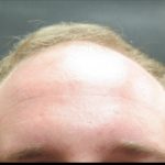 Hair Restoration Before & After Patient #1803