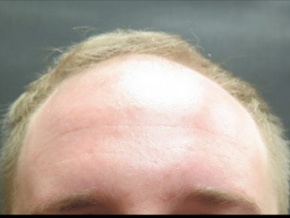 Hair Restoration Before & After Patient #1803