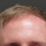 Hair Restoration Before & After Patient #1803
