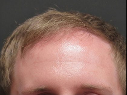 Hair Restoration Before & After Patient #1803