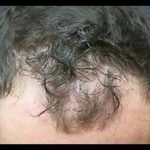 Hair Restoration Before & After Patient #1806