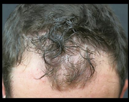 Hair Restoration Before & After Patient #1806