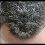 Hair Restoration Before & After Patient #1806
