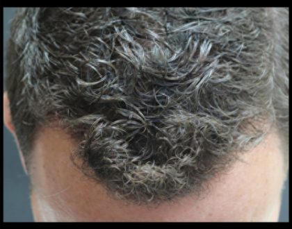 Hair Restoration Before & After Patient #1806