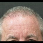 Hair Restoration Before & After Patient #1809