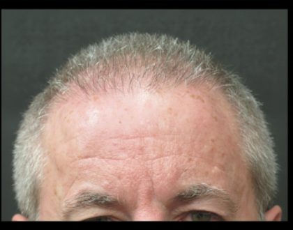 Hair Restoration Before & After Patient #1809