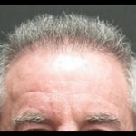 Hair Restoration Before & After Patient #1809