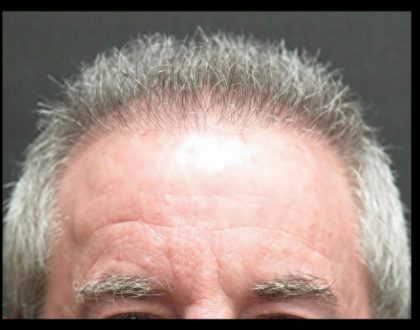 Hair Restoration Before & After Patient #1809