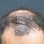 Hair Restoration Before & After Patient #1812