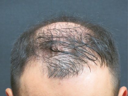 Hair Restoration Before & After Patient #1812