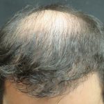 Hair Restoration Before & After Patient #1812