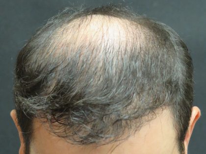 Hair Restoration Before & After Patient #1812