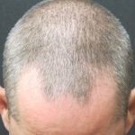 Hair Restoration Before & After Patient #1824