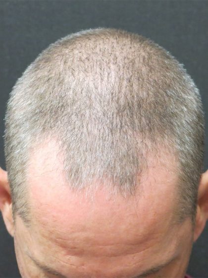 Hair Restoration Before & After Patient #1824