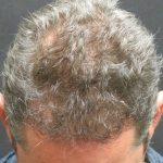 Hair Restoration Before & After Patient #1824