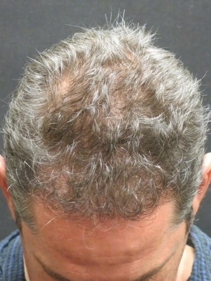 Hair Restoration Before & After Patient #1824