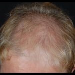 Hair Restoration Before & After Patient #1832