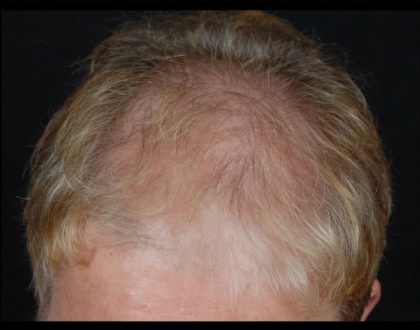 Hair Restoration Before & After Patient #1832