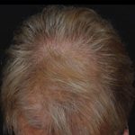 Hair Restoration Before & After Patient #1832