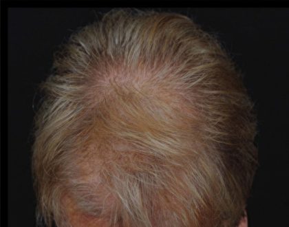 Hair Restoration Before & After Patient #1832
