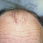 Hair Restoration Before & After Patient #1840