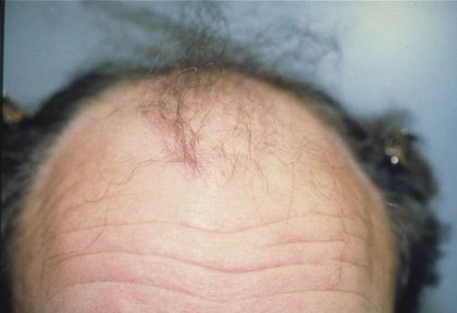 Hair Restoration Before & After Patient #1840
