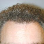 Hair Restoration Before & After Patient #1840