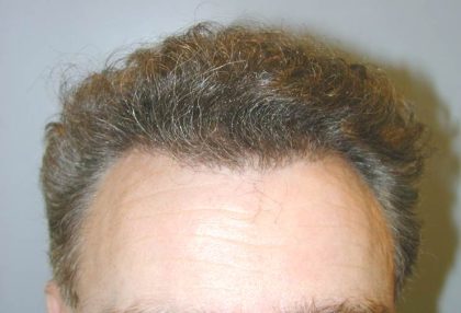 Hair Restoration Before & After Patient #1840